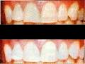 teeth bleaching photo
